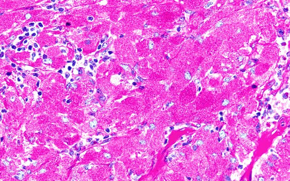 3C1 Granular cell tumor, infundibulum (Case 3) PAS 1