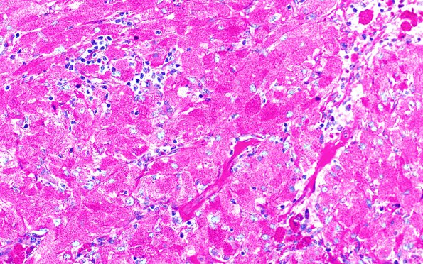 3C2 Granular cell tumor, infundibulum (Case 3) PAS with diastase 2