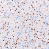 3E2 Granular cell tumor, infundibulum (Case 3) TTF-1 1