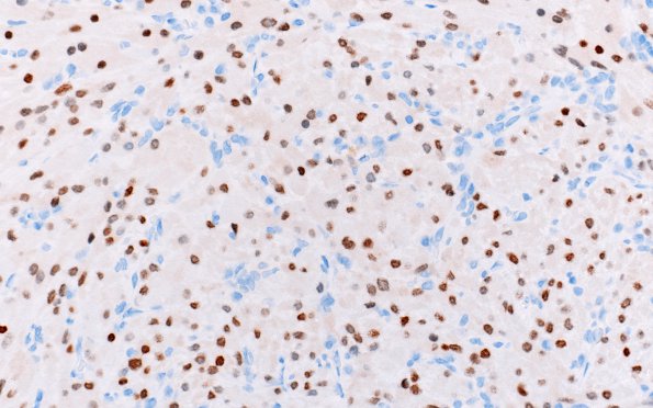 3E2 Granular cell tumor, infundibulum (Case 3) TTF-1 1