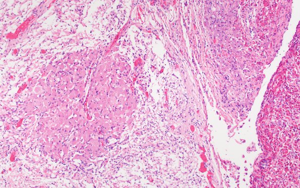 4A2 Granule Cell Tumor (Case 4) H&E 10X 2