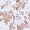 4C2 Granule Cell Tumor (Case 4) B-catenin 2