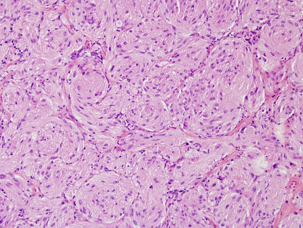 5A2 Granular Cell Tumor, colon polyp (Case 5) H&E 15