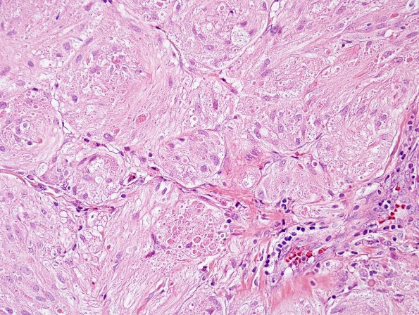 5A5 Granular Cell Tumor, colon polyp (Case 5) H&E 10