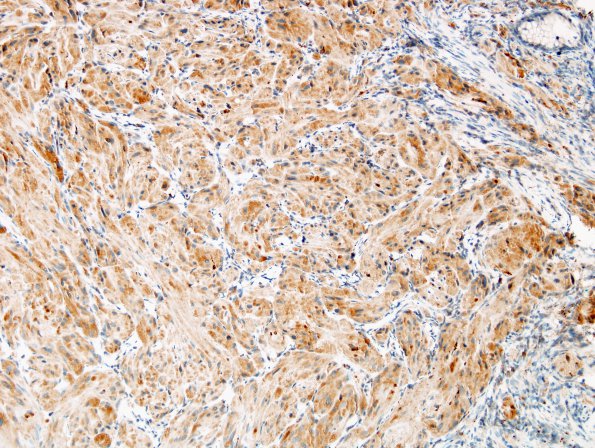 5B3 Granular Cell Tumor, colon polyp (Case 5) CD68 4