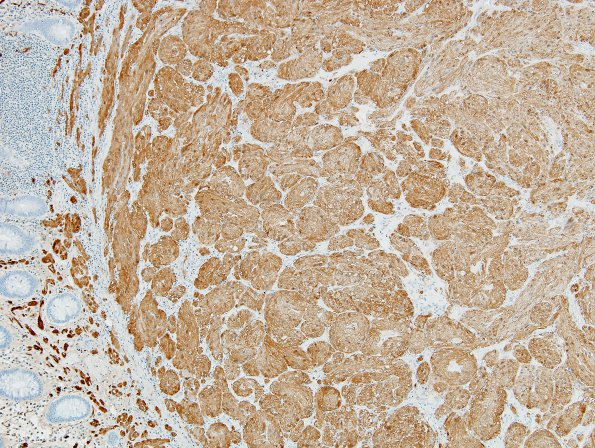 5C2 Granular Cell Tumor, colon polyp (Case 5) S100 12