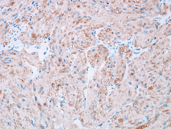 5C5 Granular Cell Tumor, colon polyp (Case 5) S100 4A