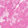 6A2 Granular cell tumor, suprasellar (AANP 1983, Case 8) H&E X5 1