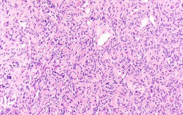 7A4 Granular cell tumor (Case 7) H&E  2nd slide 20X 3