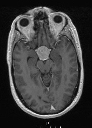 8A3 (Case 8) T1W - Copy