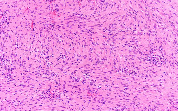 8B2 TTF1 Granular Cell Tumor (Case 8) H&E 20X 4 spindled area