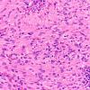 8B5 TTF1 Granular Cell Tumor (Case 8) H&E 40X