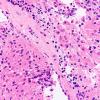 8B6 TTF1 Granular Cell Tumor (Case 8) H&E 40X 6