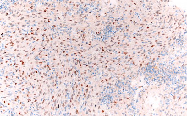 8C1 TTF1 Granular Cell Tumor (Case 8) TTF1 20X