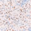 8C2 TTF1 Granular Cell Tumor (Case 8) TTF1 40X