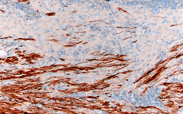 8D1 TTF1 Granular Cell Tumor (Case 8) GFAP 20X