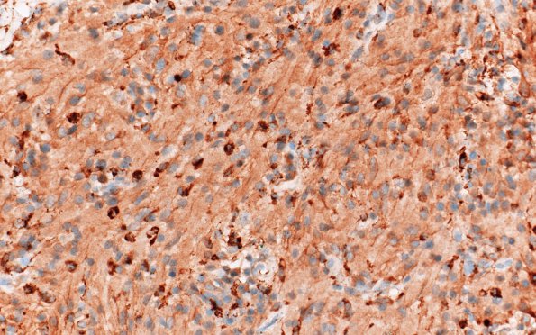 8G2 TTF1 Granular Cell Tumor (Case 8) CD68 40X 3