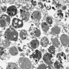 8K5 TTF1 Granular Cell Tumor (Case 8) EM 018 - Copy