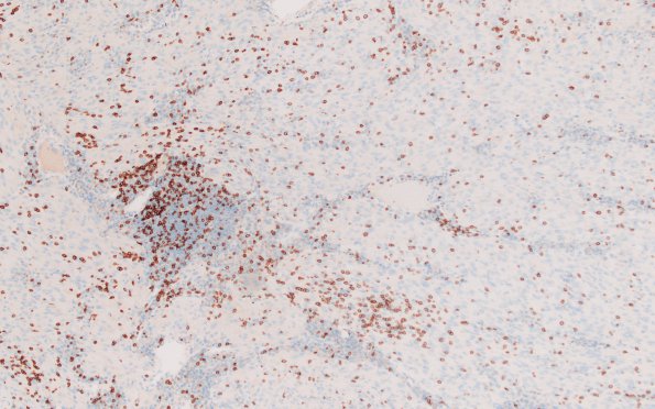 8L1 TTF1 Granular Cell Tumor (Case 8) CD3