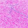 8M2 TTF1 Granular Cell Tumor (Case 8) PAS 40X 2