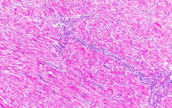 8M2 TTF1 Granular Cell Tumor (Case 8) PAS 40X 2