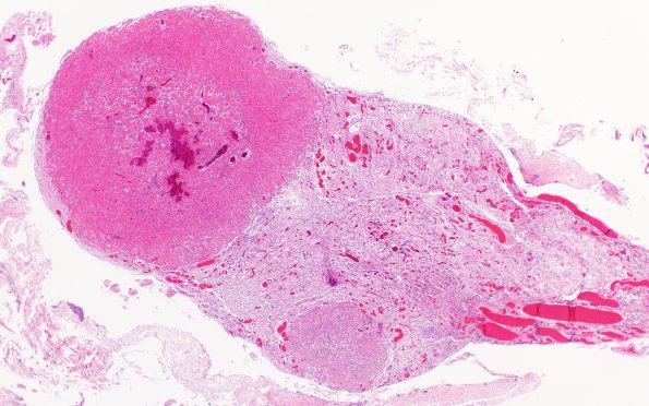 9A1Granular cell tumorlets, pituitary stalk (Case 9) H&E 2X