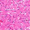 9A3 Granular cell tumorlets, pituitary stalk (Case 9) H&E 40X 2