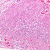 9A4 Granular cell tumorlets, pituitary stalk (Case 9) H&E 10X