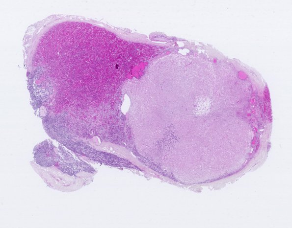 10A1 PNeoplasm basophil inv (Case10) H&E 1