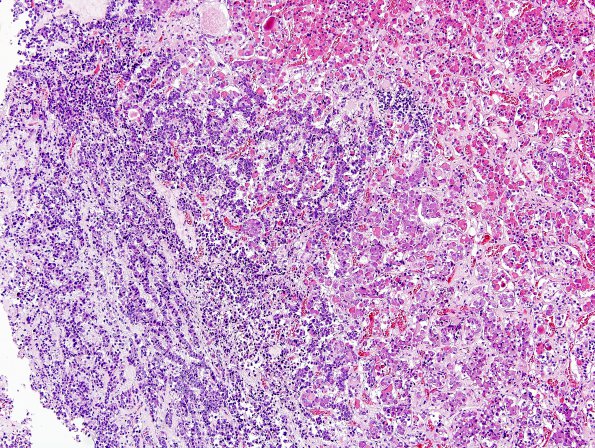 10A5 PNeoplasm basophil inv (Case10) 11