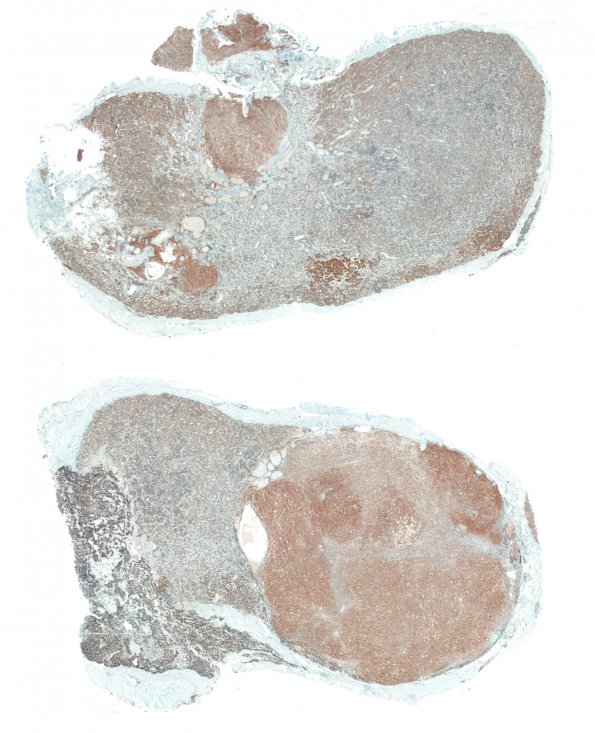 10B1 PNeoplasm basophil inv (Case10) SYN WM