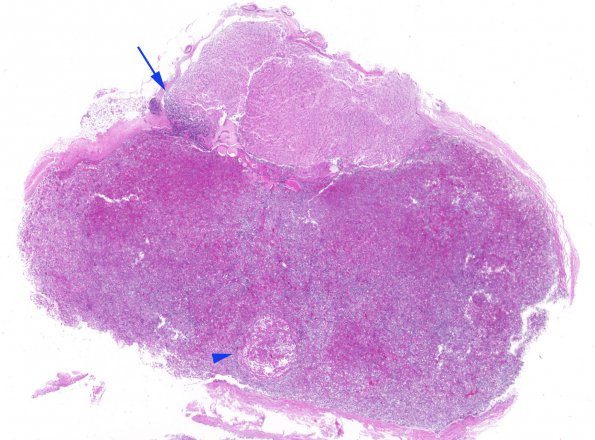 11A1 PA basophil inv (Case 11) H&E WM