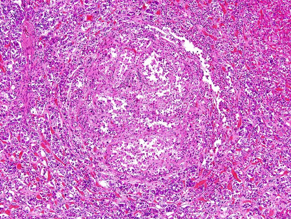 11A2 PA basophil inv (Case 11) H&E 1