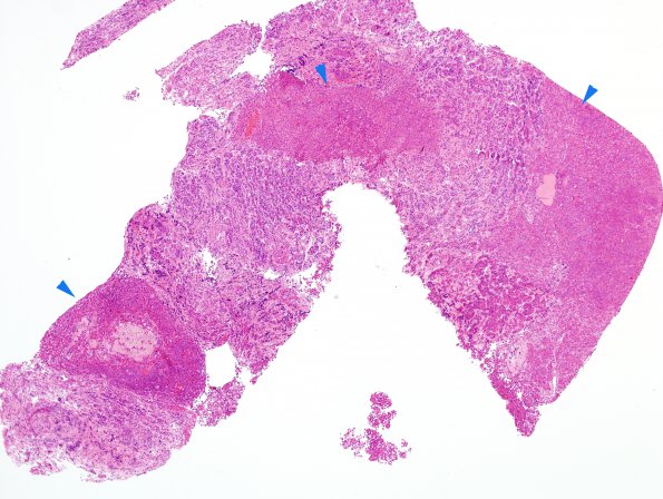 13A1 PA, ACTH, CR (Case 13) H&E 2 copy