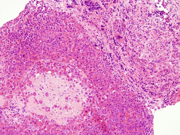 13A2 PA, ACTH, CR (Case 13) H&E 4