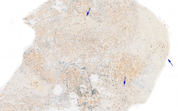 13E1 Pituitary adenoma, ACTH  (CR, Case 13) Ki67 4X 2nd copy