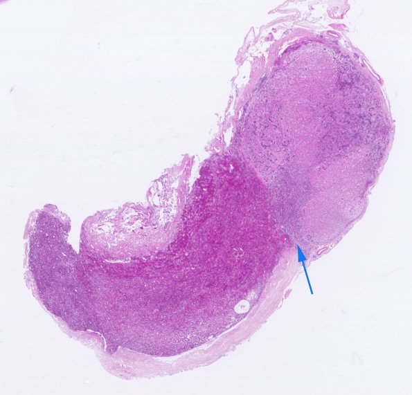 17A1 PIT basophil inv (Case 17) H&E whole mount copy