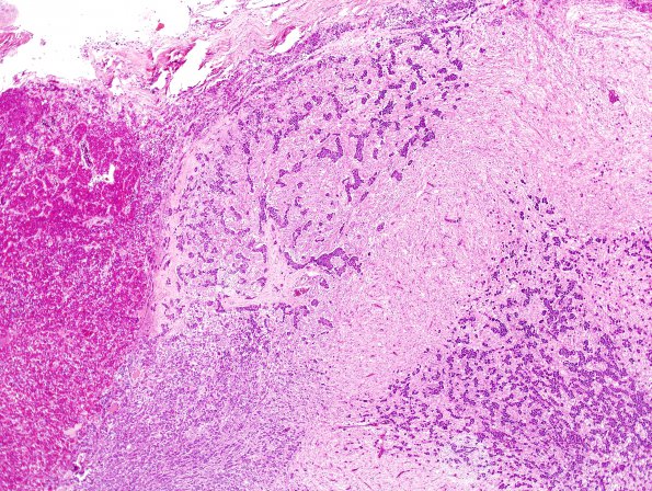 17A2 PIT basophil inv (Case 17) H&E 1