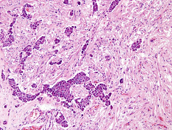 17A4 PIT basophil inv (Case 17) H&E 2