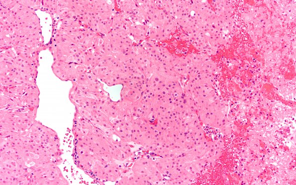 18A Pituitary adenoma (Case 18) H&E 1