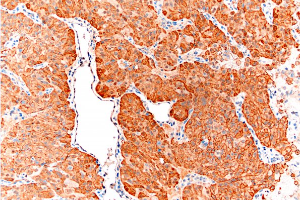 18B Pituitary adenoma (Case 18) ACTH