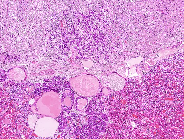 19A1 Pituitary adenoma (Case 19) H&E 3.jpg