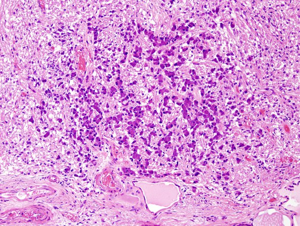 19A2 Pituitary adenoma (Case 19) H&E 2.jpg