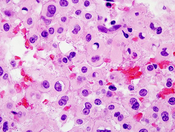 1A2 Pituitary adenoma (Case 1) H&E 3