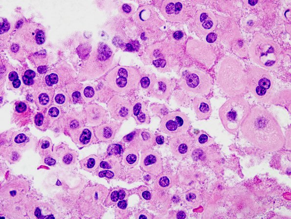 1A3 Pituitary adenoma (Case 1) H&E 5