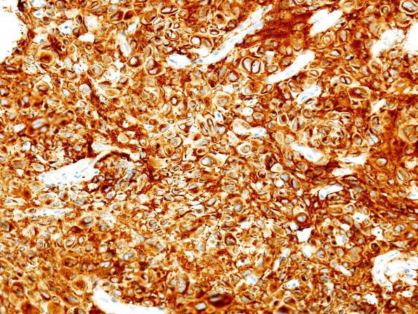 1B Pituitary adenoma (Case 1) SYN 2