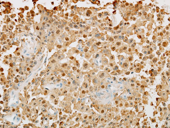 1C Pituitary adenoma (Case 1) ACTH 2