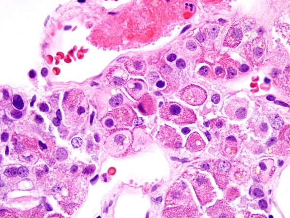 22 Pituitary Adenoma (Case 22) H&E 1