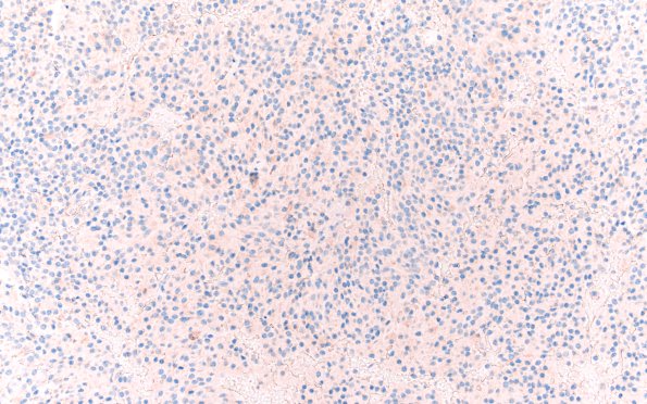 24B1 Pituitary Adenoma (Case 24) ACTH 20X