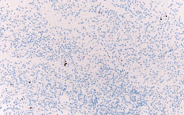 24C Pituitary Adenoma (Case 24) Ki67 20X